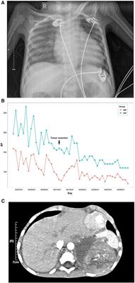 Case report: Catecholamine cardiomyopathy in children with neuroblastoma